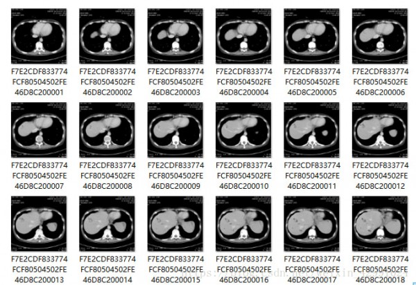 MicroDicom viewer(Dicom格式看图软件)